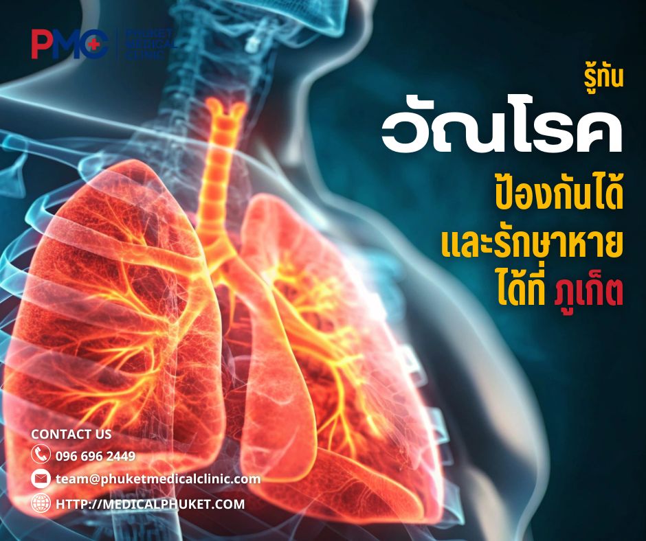 รู้ทันวัณโรค ป้องกันได้ และรักษาหายได้ที่ภูเก็ต