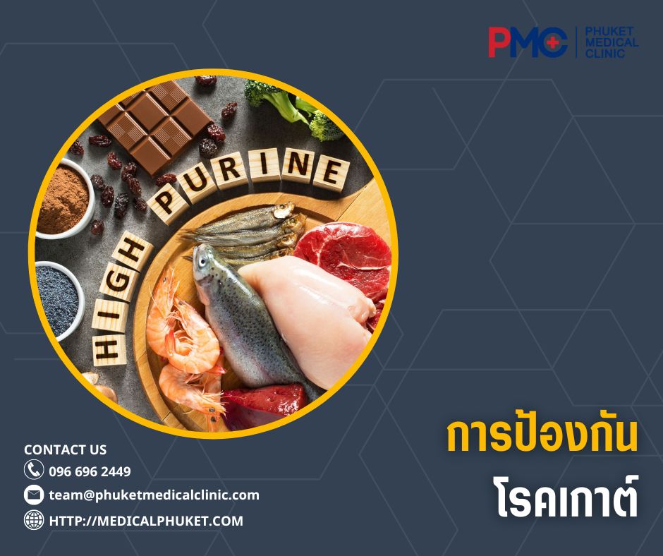 การป้องกันโรคเกาต์