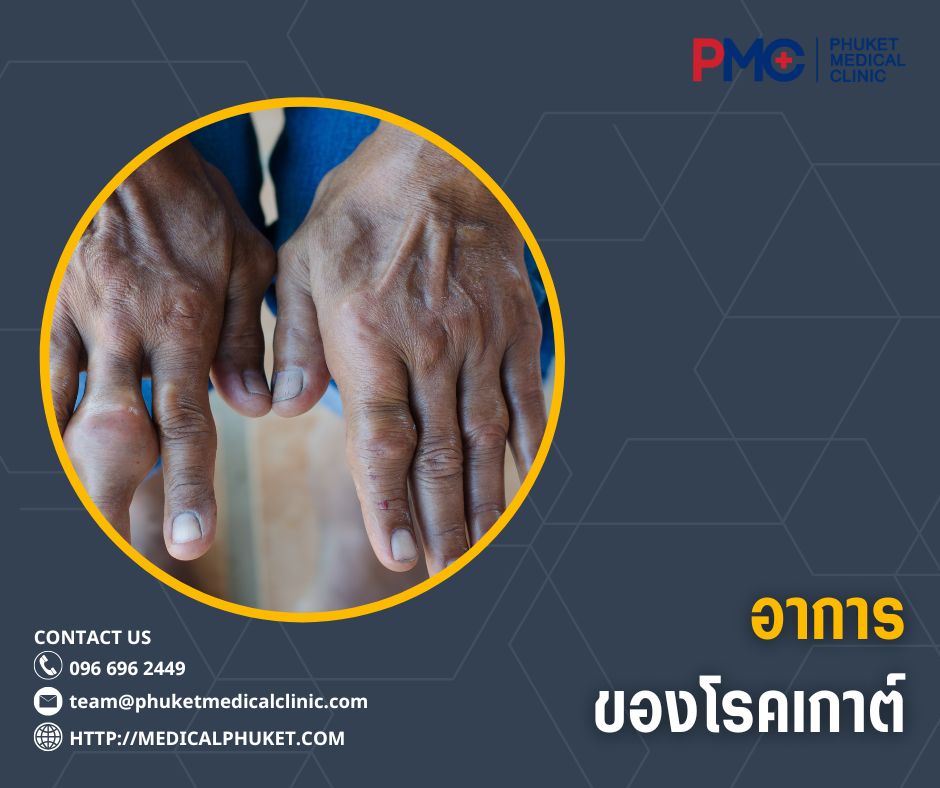 อาการของโรคเกาต์