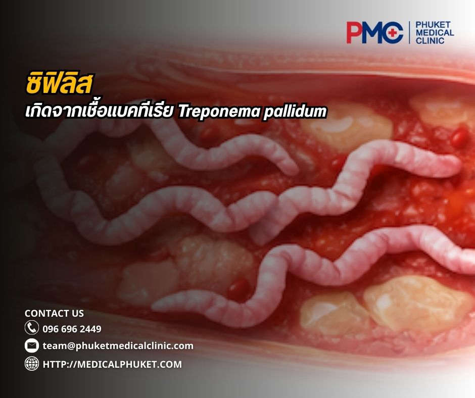 ซิฟิลิส เป็นโรคติดต่อทางเพศสัมพันธ์ที่เกิดจากเชื้อแบคทีเรีย Treponema pallidum