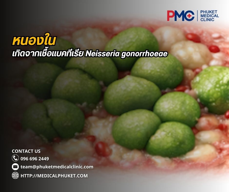 หนองใน เป็นโรคติดต่อทางเพศสัมพันธ์ที่เกิดจากเชื้อแบคทีเรีย Neisseria gonorrhoeae