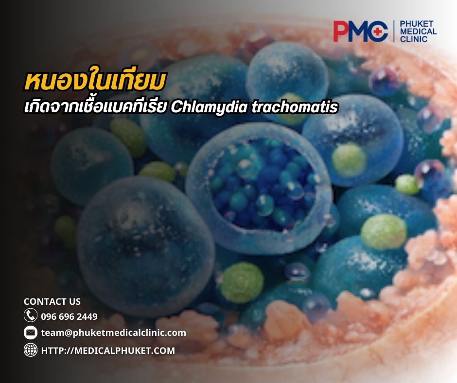 หนองในเทียม เกิดจากเชื้อแบคทีเรีย Chlamydia trachomatis