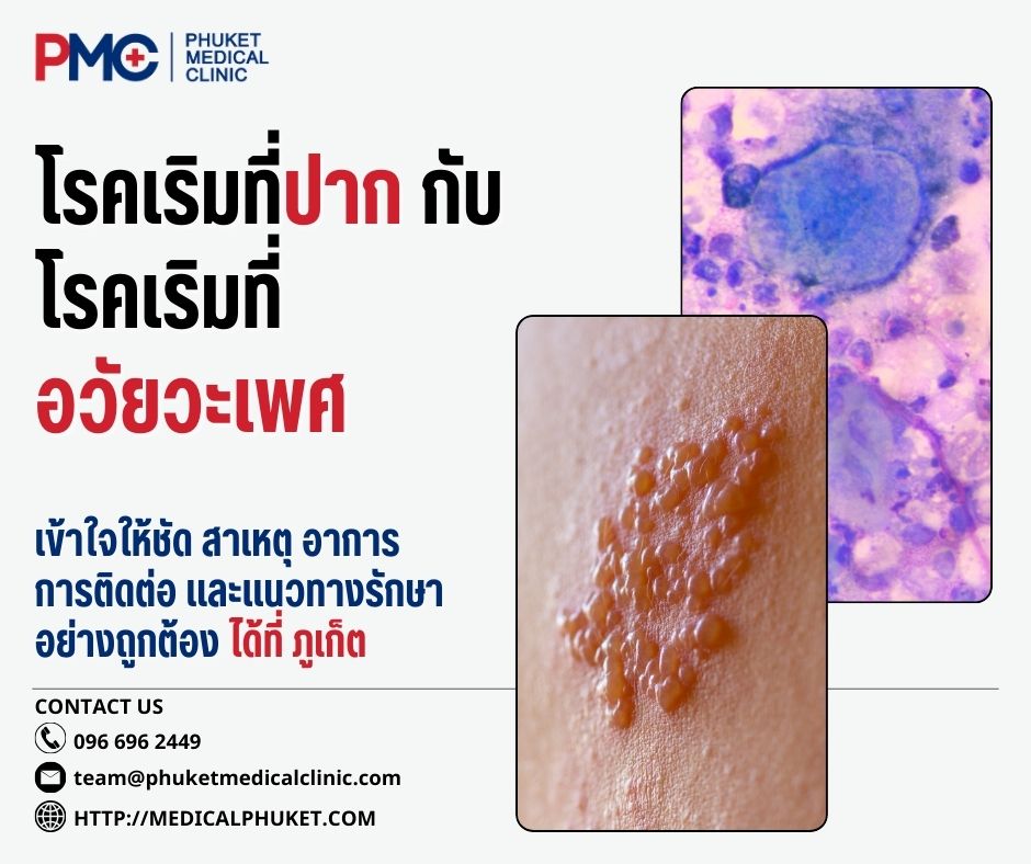 โรคเริมที่ปาก กับโรคเริมที่อวัยวะเพศ เข้าใจให้ชัด สาเหตุ อาการ การติดต่อ และแนวทางรักษาอย่างถูกต้อง ได้ที่ ภูเก็ต