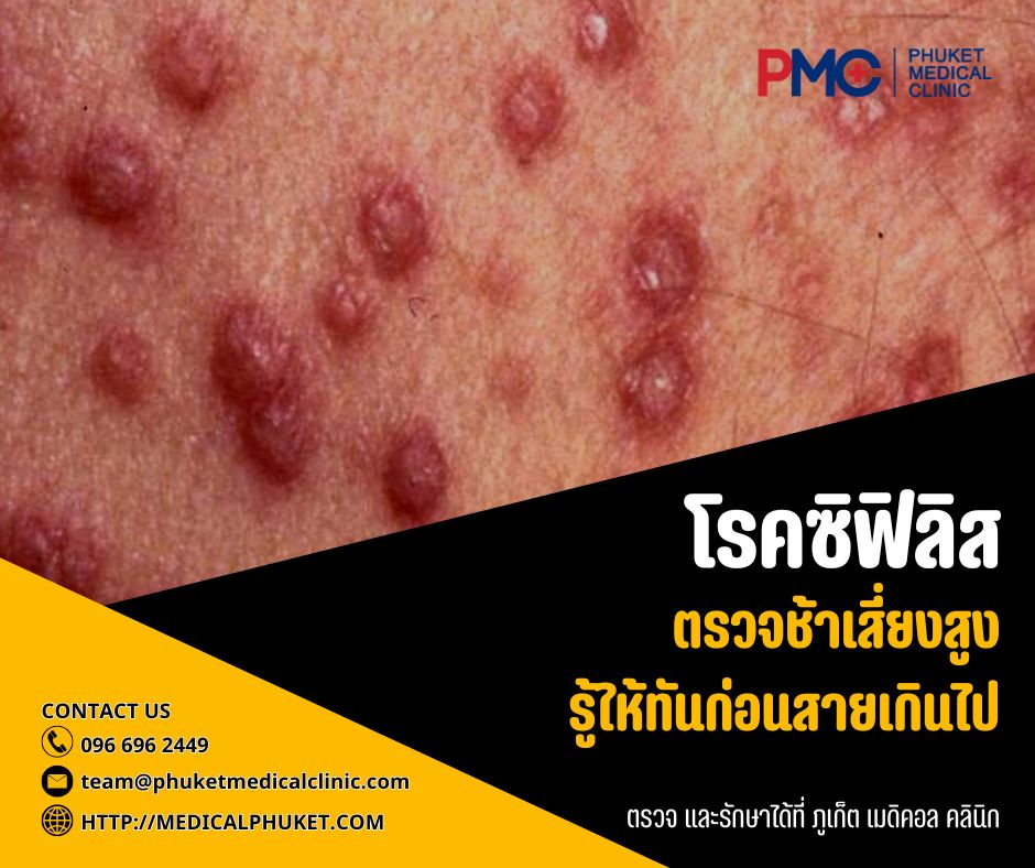 โรคซิฟิลิส ตรวจช้าเสี่ยงสูง รู้ให้ทันก่อนสายเกินไป