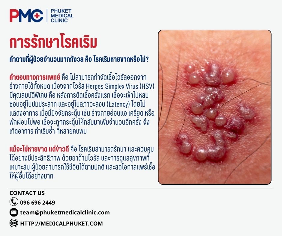 การรักษาโรคเริม