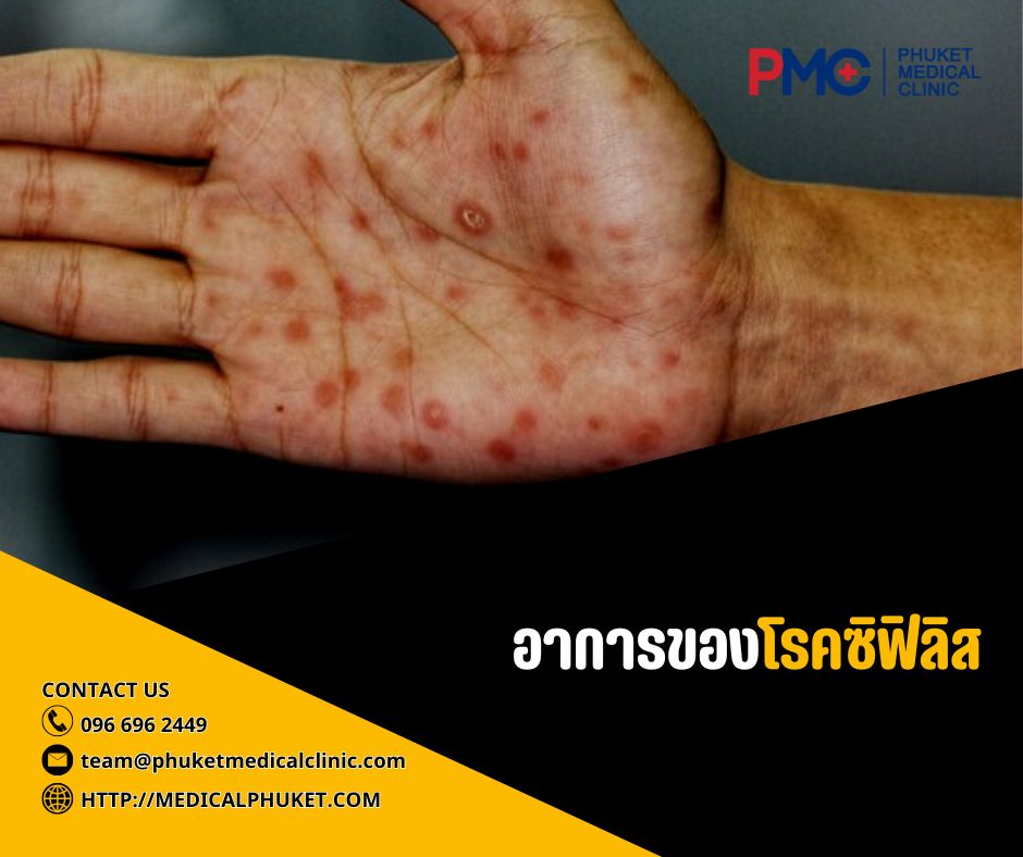 อาการของโรคซิฟิลิส