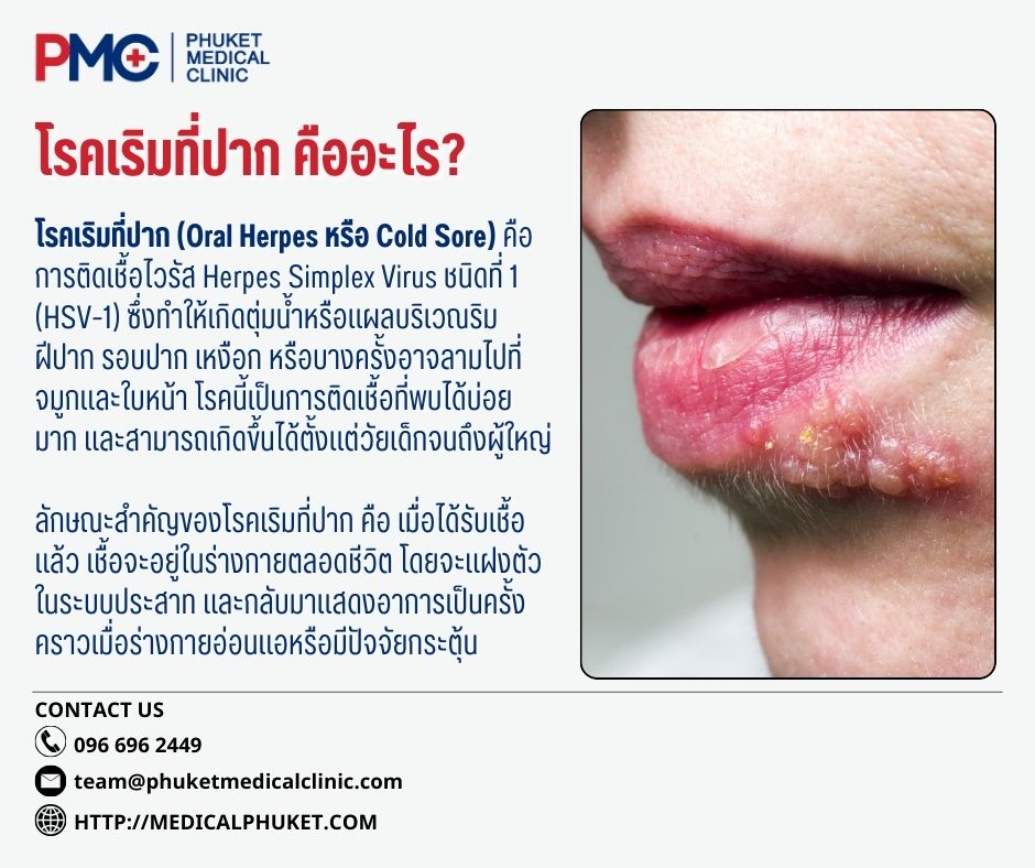 โรคเริมที่ปาก คืออะไร