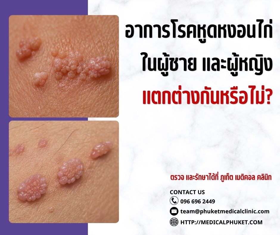 อาการโรคหูดหงอนไก่ในผู้ชายและผู้หญิง แตกต่างกันหรือไม่?
